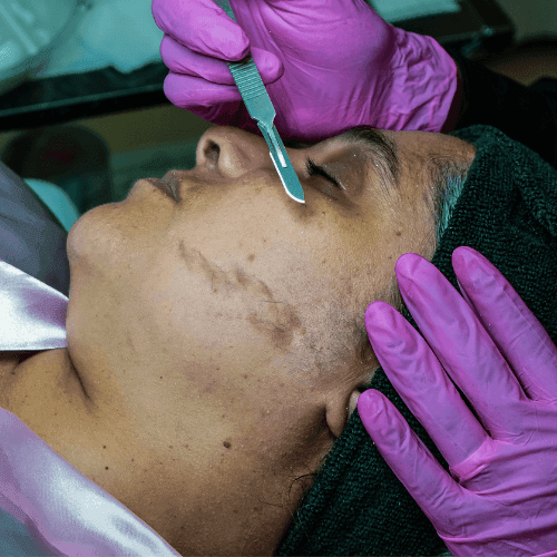 Dermaplaning